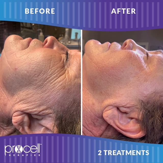 (3) Microchanneling Package at Polished Pearl in Columbus, OH